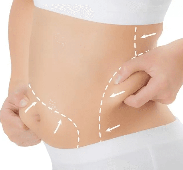 Lipolysis – Fat-Dissolving Injection image