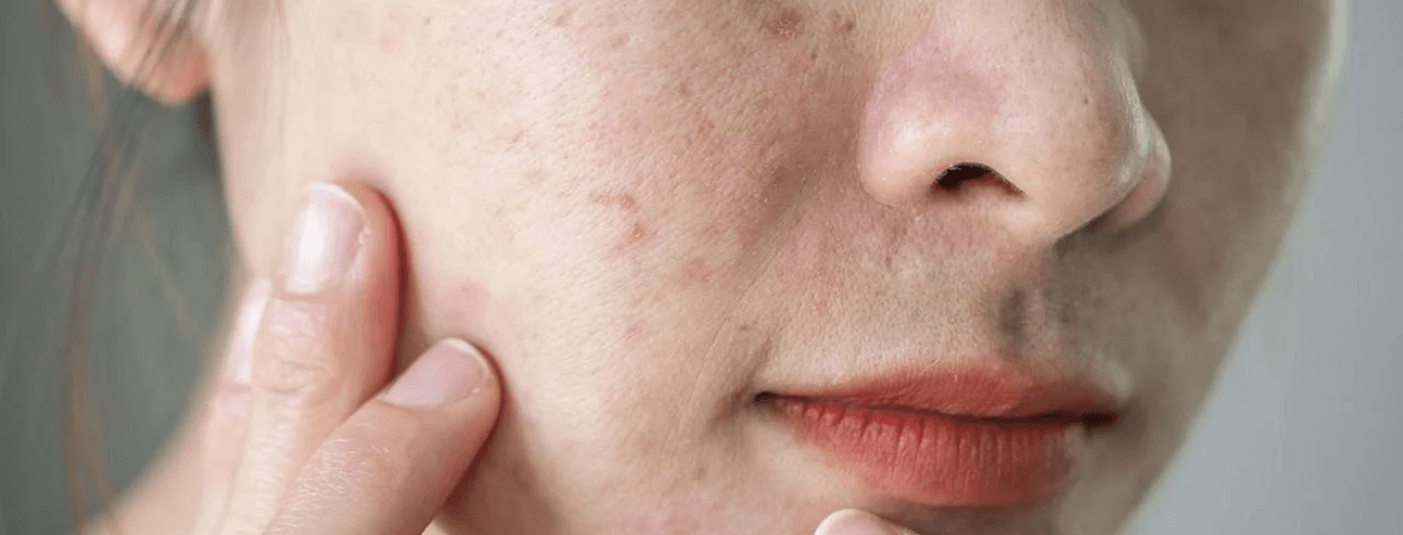 Acne treatment image