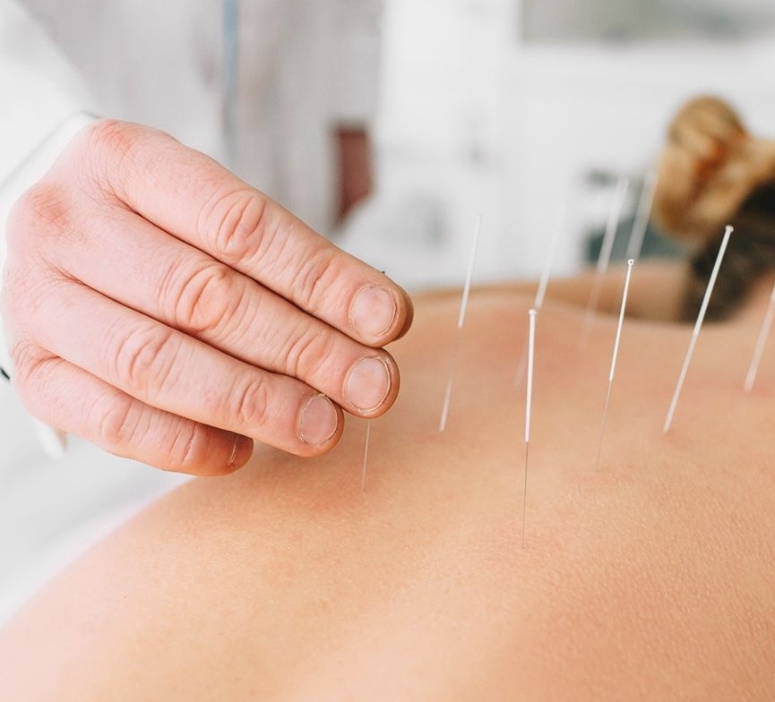 General accupuncture image