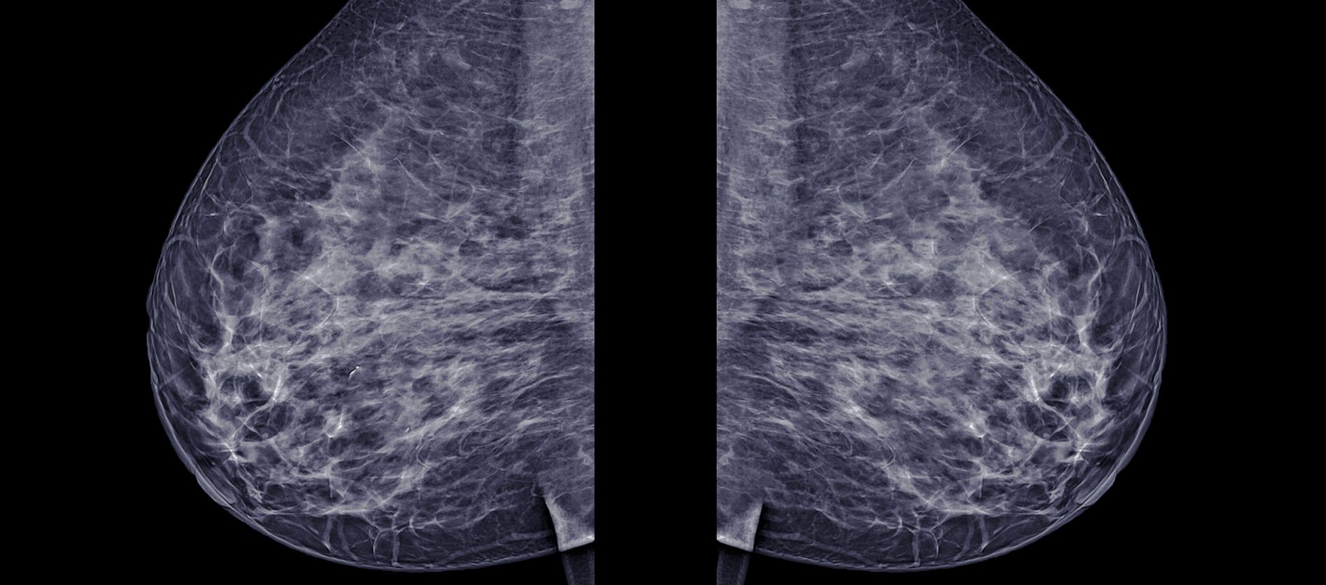 Breast Cancer image