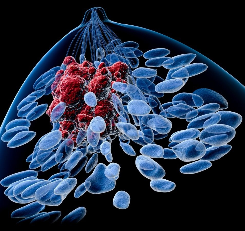 Breast Cancer image