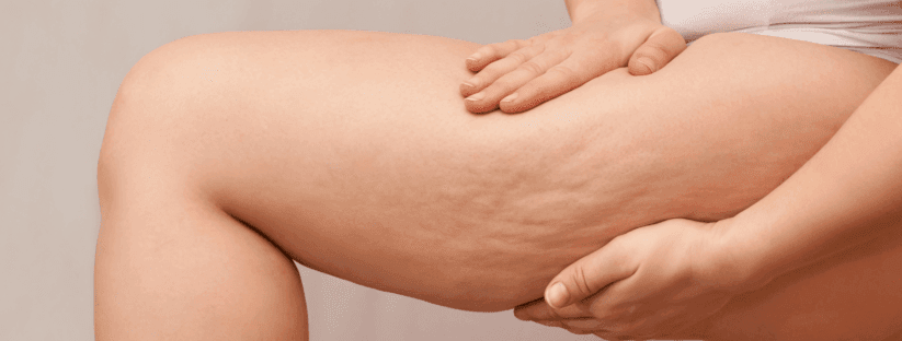 Cellulite image