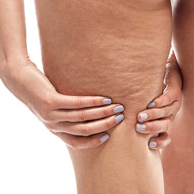 Cellulite image