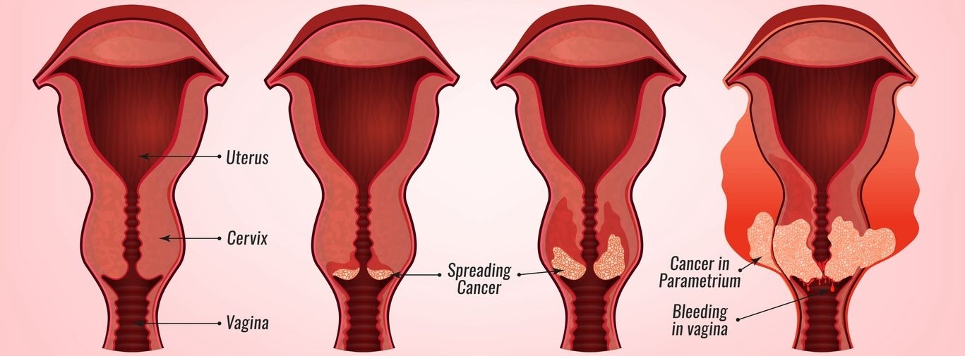 Cervical Carcinoma image