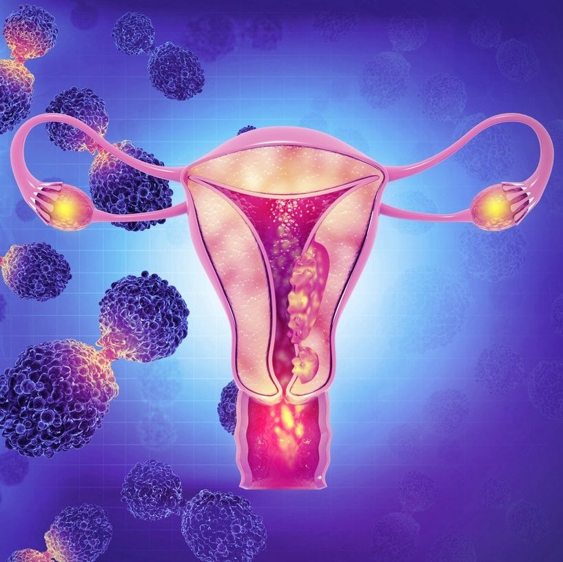 Endometrial Cancer image