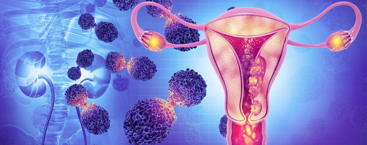 Endometrial Cancer image