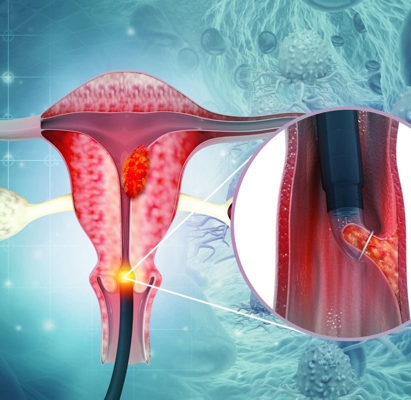 Hysteroscopy (Uterine Cavity Examination) image
