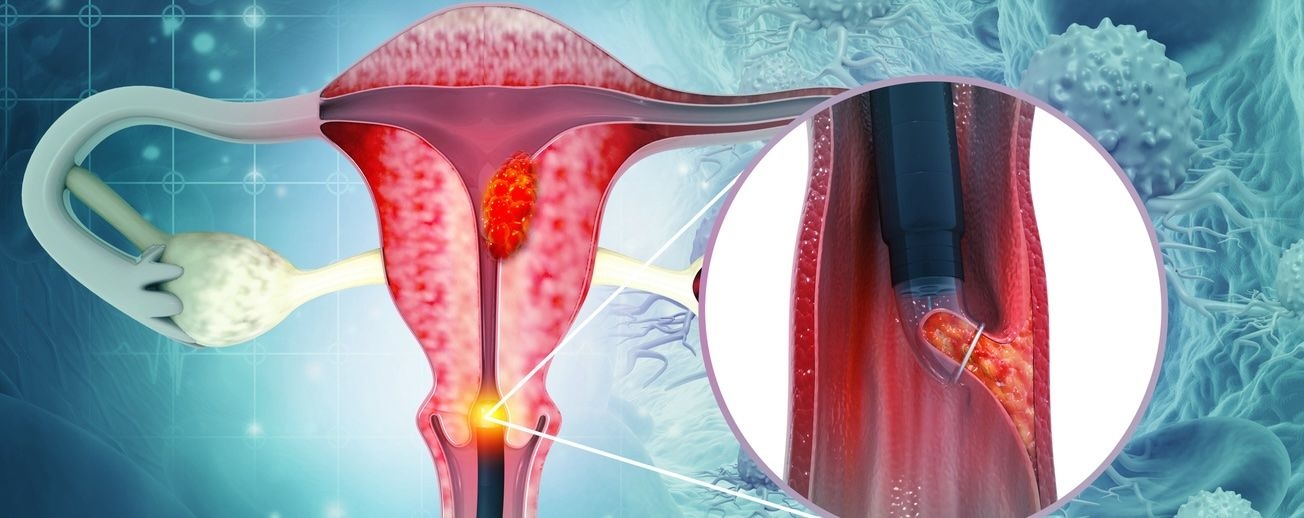 Hysteroscopy (Uterine Cavity Examination) image