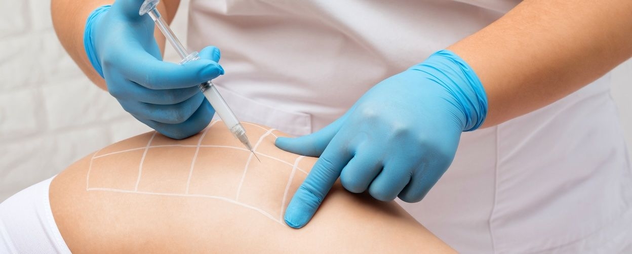 Lipolysis – Fat-Dissolving Injection image