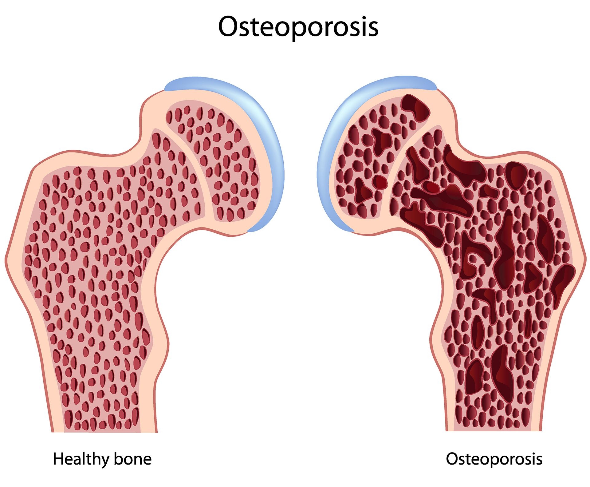 Osteoporosis image