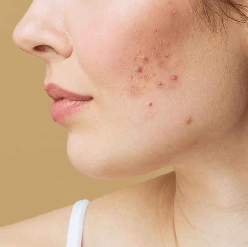 Acne treatment image