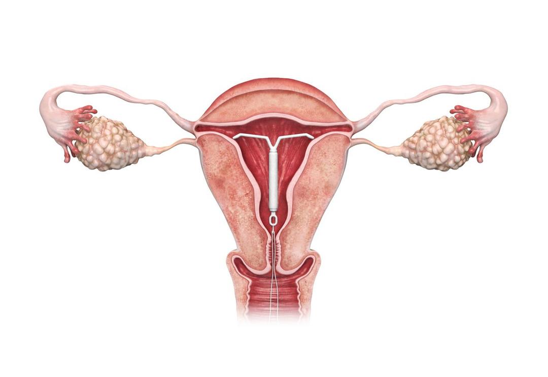 IUD sterilet.jpg