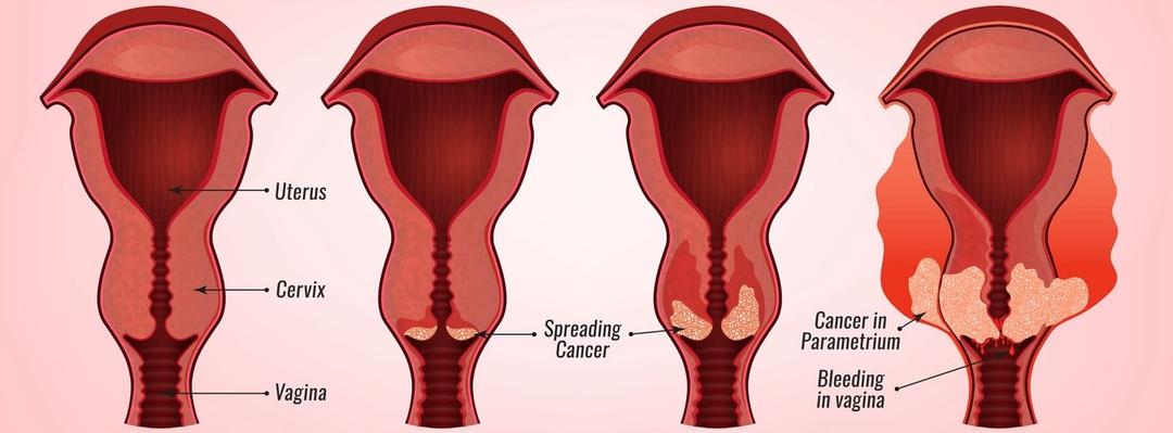 cervical cancer lung.jpg