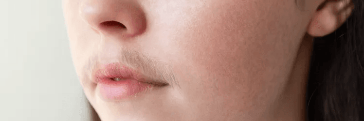 Hirsutism - Unwanted Hair Growth image