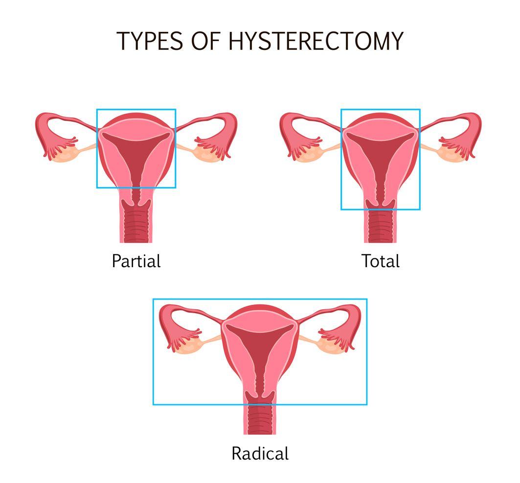 hyterectomy.jpg